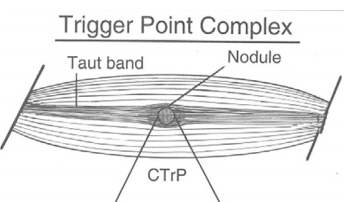 טריגר פוינט - גבעון פלד ומחה להפגת כאב
